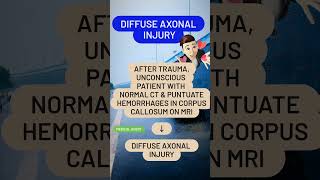 Diffuse axonal injury [upl. by Claresta]