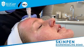 Skinpen Microneedling How it Works amp Demonstration  SLUCare MedSpa [upl. by Anyer471]