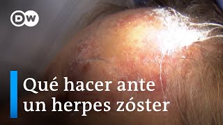 Primero varicela luego herpes zóster [upl. by Anrev58]