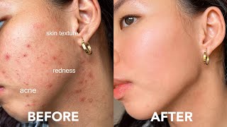 EASY WAY TO GET RID OF ACNE tiny bumps redness texture acne scars [upl. by Vaughan]