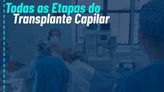 Etapas do transplante capilar  Transplante de cabelo do planejamento ao pósoperatório [upl. by Sapphire]