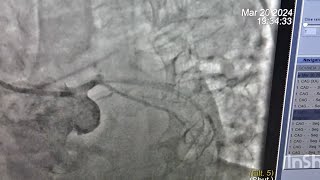 LMLAD stentingcomplex angioplasty in 76yrs old with AWMIheart attack LAD 100 ostial block [upl. by Oriana]