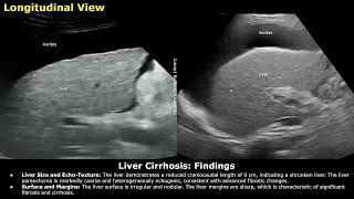 Liver Cirrhosis With Portal Hypertension Ascites amp Splenomegaly Ultrasound Report Example  USG [upl. by Otrebide]