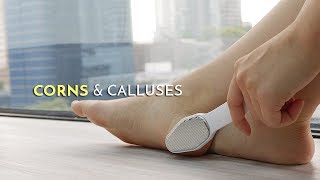 How to Manage Corns and Calluses  Podiatrist Georgina Tay East Coast Podiatry [upl. by Phi667]