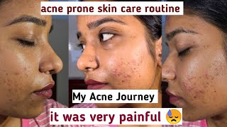 My Acne Journey it was very painful acne prone skin care routine [upl. by Pero205]