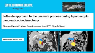 Laparoscopic Leftside approach to uncinate process during pancreaticoduodenectomy [upl. by Ulda130]