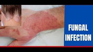 Fungal infectionskin Dr how to treat fungal infection [upl. by Mercier]