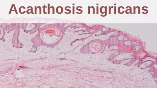 Acanthosis Nigricans  Pathology mini tutorial [upl. by Alverta]