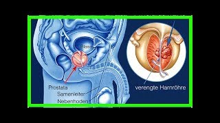 Dies sind die 10 wichtigesten Symptome für Prostatakrebs [upl. by Knuth]