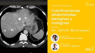 Calcificaciones abdominales benignas y malignas por el Dr Alfredo Montemayor Elizondo [upl. by Riggins221]