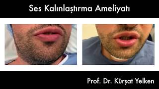 Ses Kalınlaştırma Ameliyatı öncesiampsonrası ses kaydı Voice Deepening Surgery preamppostop voice [upl. by Ariam]