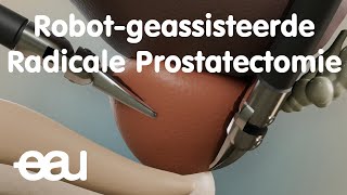 Robotgeassisteerde Radicale Prostatectomie [upl. by Annaliese272]