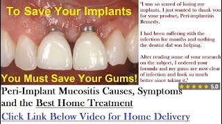 Peri Implant Mucositis Causes Symptoms and the Home Treatment That Works [upl. by Leipzig]