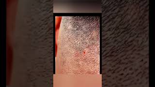 ingrown hair removal [upl. by Survance]