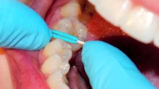 PHM Orthodontists Separator Video [upl. by River]