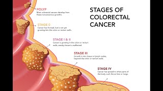 How to Treat Colon Cancer [upl. by Ellenehc]