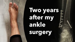 Two years after my ankle surgery  Trimalleolar ankle fracture [upl. by Eirroc]