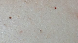 Acne Treatment on the Back Uninfected Lesions [upl. by Asaert932]