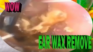 Ear Wax Deep Impacted Hard Stuck Ear Wax Removal amp Cleaning Sap124 [upl. by Haakon812]