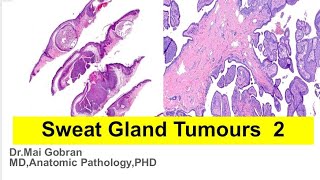 Pathology of sweat glands tumours part 2 [upl. by Eetak481]