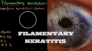 Filamentary Keratitis  Ophthalmology [upl. by Bevan177]