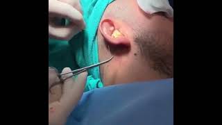 Otoplasty Surgery Under Local Anesthesia [upl. by Akeemahs]