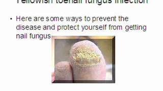 toe nail fungus home remedies [upl. by Gowrie933]