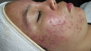 Remedio Para Secar El Acné  Homemade Acne Treatment  Ecodaisy [upl. by Anaidni]