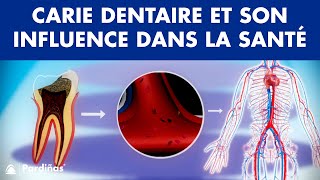 Carie dentaire et son influence dans la santé © [upl. by Lyall]