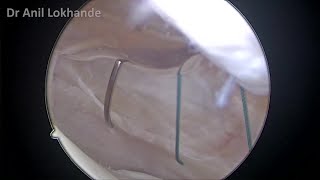 Arthroscopic Medial Retinaculum Plication amp Lateral Release Patella by Dr Anil Lokhande [upl. by Peggy]