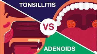 What is Adenoids and Tonsillitis Complete Video [upl. by Iznik29]