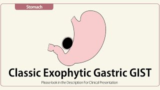 Classic Exophytic Gastric GIST [upl. by Wolk]