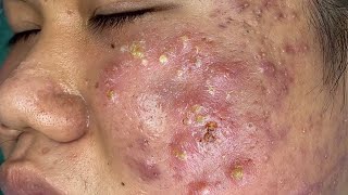 Big Cystic Acne Blackheads Extraction Blackheads amp Milia Whiteheads Removal Pimple Popping  176 [upl. by Notyalc]