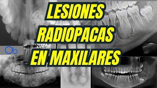 Lesiones Radiopacas en Maxilares 💀🩻 [upl. by Immak]