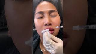 Natural Lip Filler Results with Restylane Kysse [upl. by Griselda85]