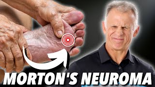 Mortons Neuroma Absolute Best Treatment In Our Opinion [upl. by Ellahcim583]