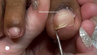 Lets Revisit  Impacted Toenail Cuticle Removal w Acrylic Correction amp ASMR [upl. by Mireielle]