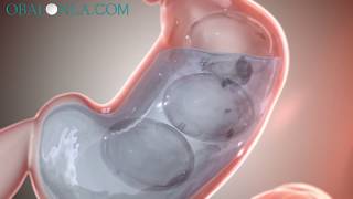 Obalon Gastric Balloon Los Angeles 2020Dr David DavtyanBeverly Hills GlendaleRancho Cucamonga [upl. by Einohpets223]