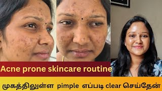 How I cleared my acne  Acne prone skincare routine  Products that I used for acne acneproneskin [upl. by Cardew]