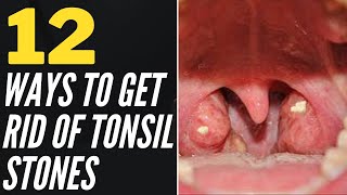 12 Ways To Get Rid Of Tonsil Stones At Home [upl. by Asusej]