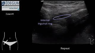 Episode 32 Round ligament varicosity [upl. by Eciryt378]