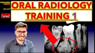 Radiographs Lesion Training Mixed Lesions Periapical X Ray and OPG interpretation dental students [upl. by Polito]