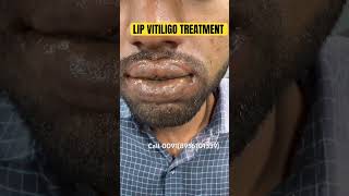 100 lip VITILIGO PERMANENT TREATMENT VITILIGO lip SAFED DAAG  lipvitiligotreatment shorts cure [upl. by Ellehsat967]