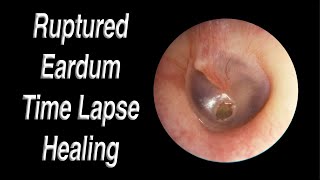 Ruptured Eardrum Healing Closed Time Lapse  A Hole in Eardrum Usually Heals Closed on Its Own [upl. by Ailegnave]