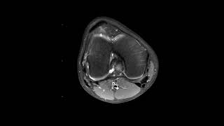 Lateral patellar subluxation and tilt [upl. by Reneta]