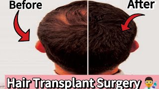 Hair Transplant 5 months Result [upl. by Leigha]