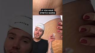 HOW TO GET RID OF STRETCH MARKS😱 follow for more💗 beauty beautytips skincare skin [upl. by Ecirtal108]