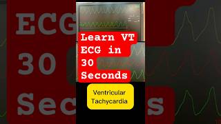 Ventricular tachycardia ecg amp treatment cardiology in 30 seconds [upl. by Puttergill648]