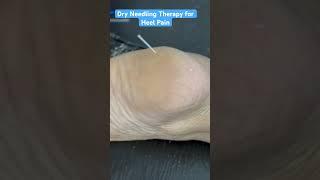 Dry Needling Treatment for Heel pain dryneedlingtherapy physiotheraphy heelpain [upl. by Diane]