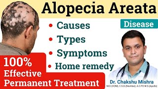 Alopecia areata homeopathic medicine Homeopathic treatment of Alopecia Areata RxHpathy [upl. by Rayburn982]